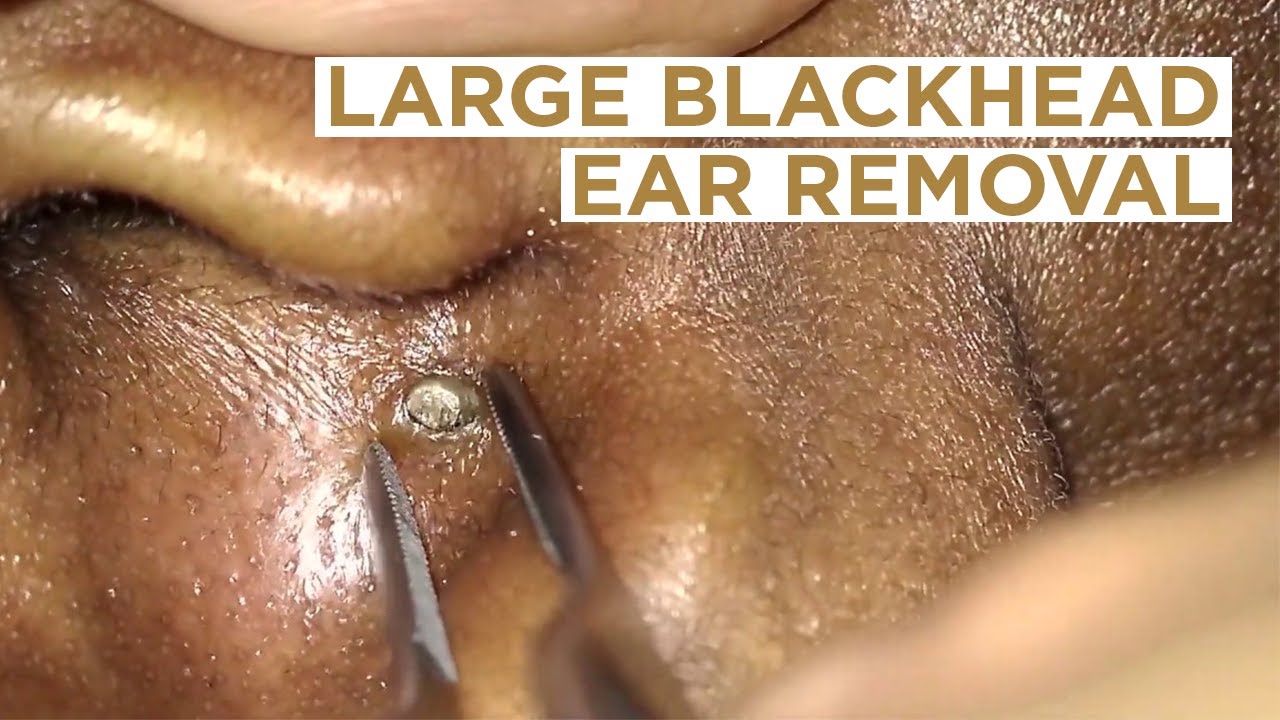 Large blackhead removed from the ear | Dr Cameron McIntosh