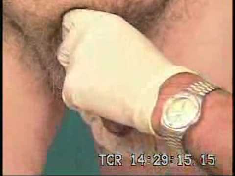 Multicomponent Coloplast Inflatable Penile Prosthesis Demonstration in a Patient with Vascular ED