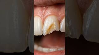 Extreme Broken Tooth Restoration! 🦷✨ #satisfying #dentistry