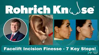 The Art Of Facelift Incision Finesse-The 7 Key Steps