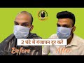 2 घंटे में गंजापन दूर करें | Hair Replacement in 2 hours | 9837384242 #hairwig
