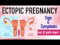 What is Ectopic Pregnancy Signs and Symptoms in Hindi | Ectopic Pregnancy Kya Hoti hai Lakshan