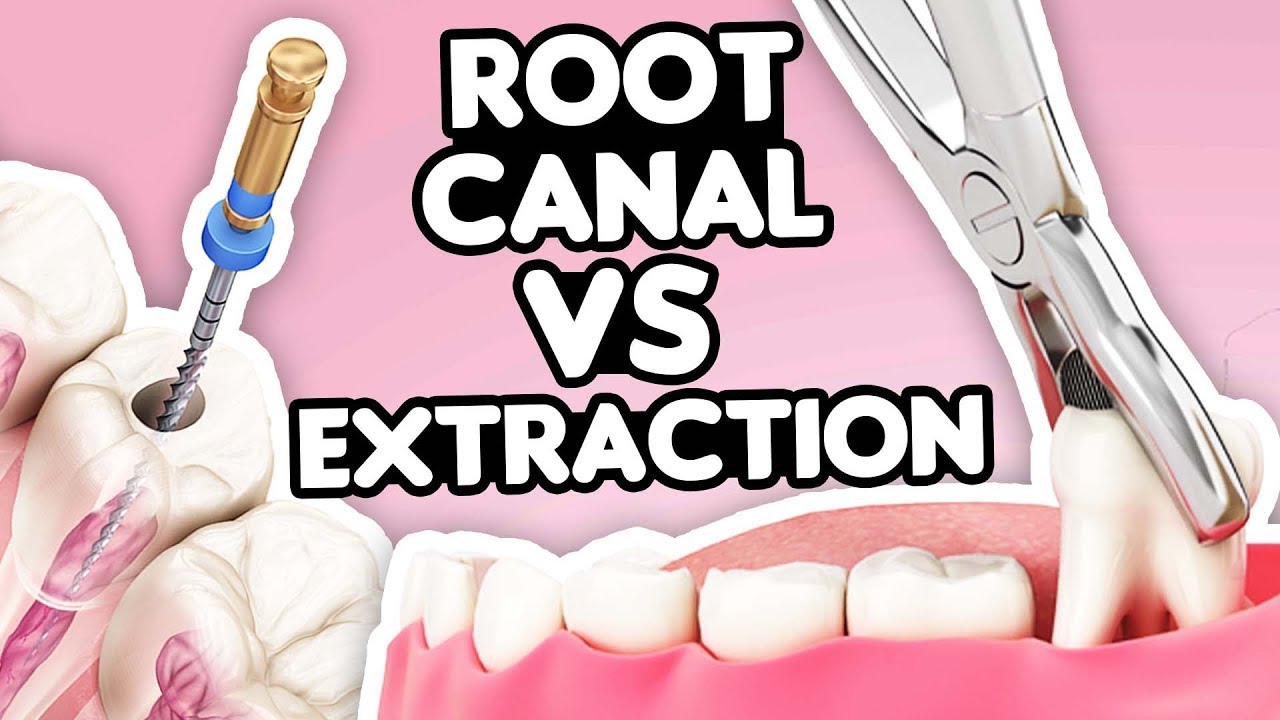 Root Canal Vs. Tooth Extraction: What’S The Right Choice?