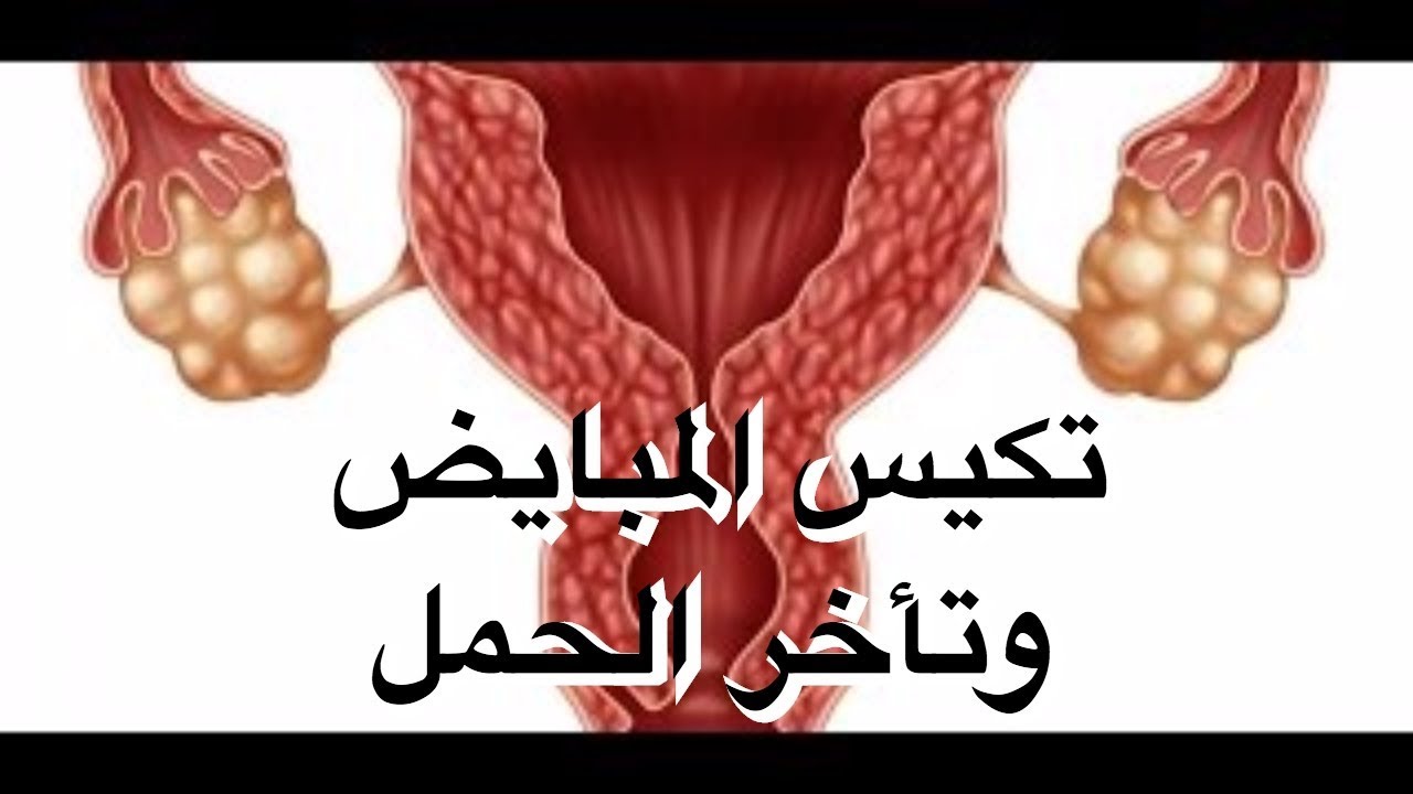 ما هوتأثير تكيس المبيض على حدوث الحمل مع الدكتور #أحمد_راجح | #طبيبك_اليوم