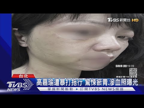 高嘉瑜遭暴打拖行 驚悚瘀青.滲血照曝光｜TVBS新聞