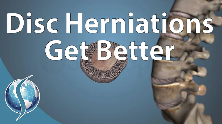 Can a Disc Herniation Heal Itself? - DayDayNews