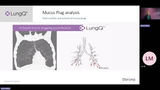 Full Webinar: Advancing Bronchiectasis Clinical Trials with AI Powered Image Analysis Guide