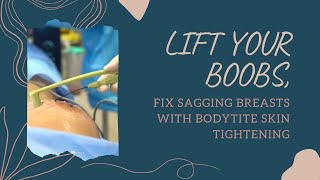 LIFT YOUR BOOBS,  FIX SAGGING BREASTS WITH BODYTITE SKIN TIGHTENING | West Hollywood |Dr. Jason Emer screenshot 2