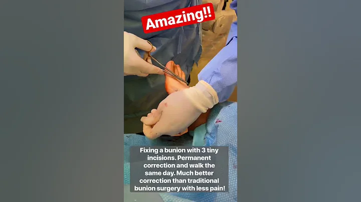 AMAZING BUNION SURGERY!!😱#shorts