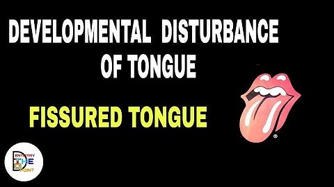 DEVELOPMENTAL DISTURBANCES OF TONGUE - FISSURED TONGUE