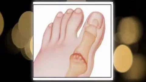 Foot Arthritis Explained | Podiatrist | Dr. Marc B...