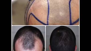 Transplante Capilar FUE - Dr. Thiago Bianco