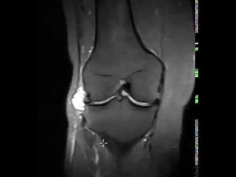 Video: Knee Meniscus Cyst