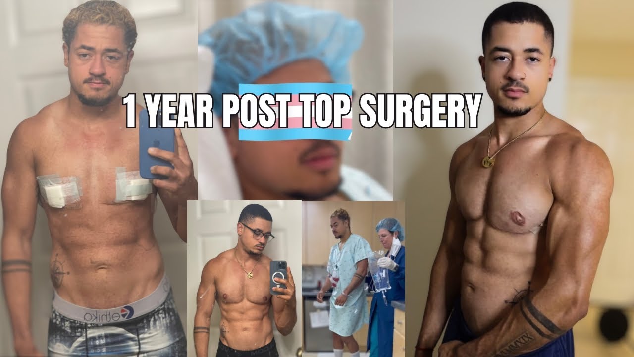 Post op depression | 1 YEAR POST TOP SURGERY