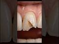 He thought it was just a small chip #teeth #teethcare #teethcleaning #dental