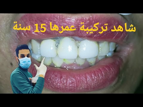 فيديو: كيفية إصلاح تاج الأسنان المفقود: 15 خطوة (بالصور)