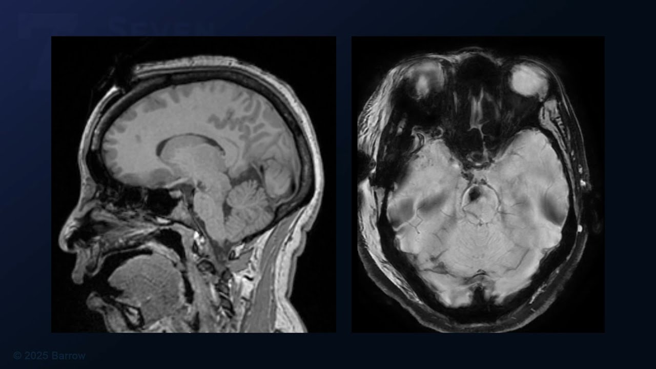 Orbitozygomatic Craniotomy and Transsylvian-Transpeduncular Approach for Midbrain Cav Mal Resection