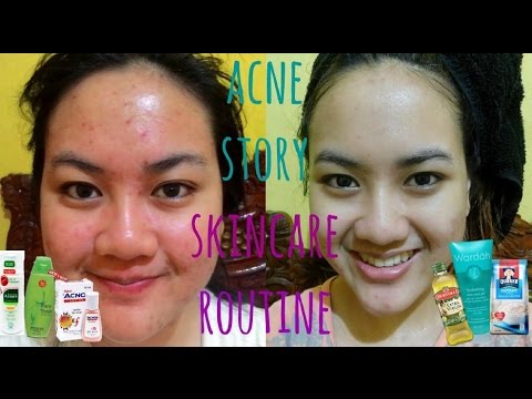 Skincare Murah untuk kulit berjerawat || Review Garnier Pure Active Sensitive. 