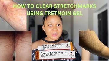 Best treatment for Stretch marks using just One Products