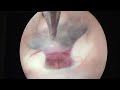Эндоскопическая вентрикулостомия третьего желудочка