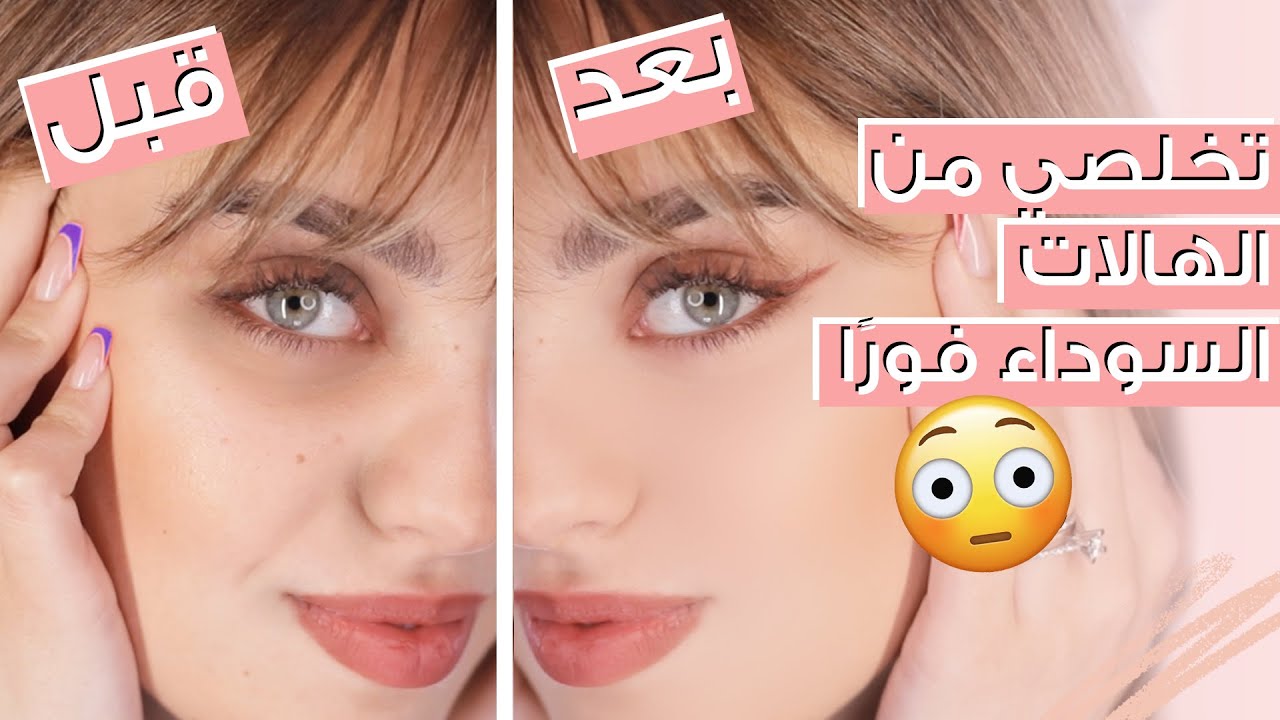 الحقيقة وراء التخلص من الهالات السوداء بأسبوع واحد وبخلطات طبيعية🌵 🍯 🍃 مع نجلا