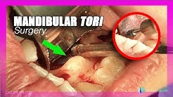 Mandibular Tori (surgery)(Removal) 