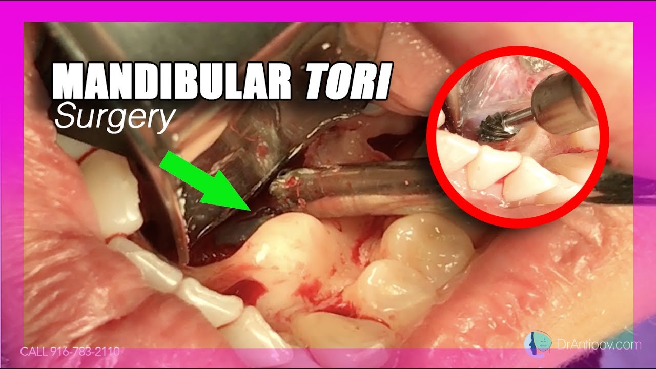 Mandibular Tori (Surgery)(Removal)