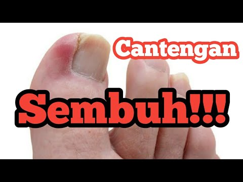 Cara Mengobati Cantengan di Jempol Kaki atau Jari Tangan Tanpa Cabut