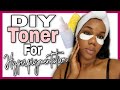BEST DIY Toner For Hyperpigmentation! How To Fade Dark Acne Spots