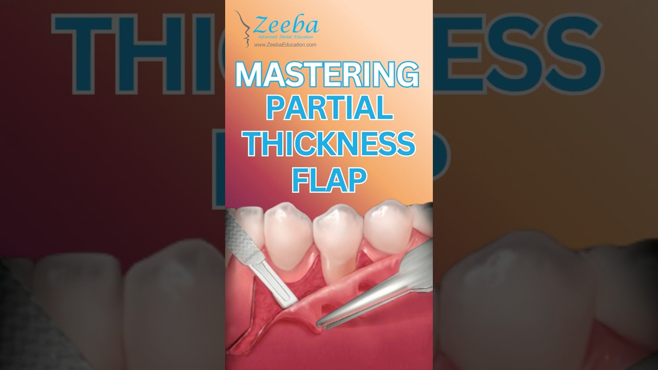 Partial Thickness Flap Dissection: Avoiding Mobile Tissue in Soft Tissue Grafts