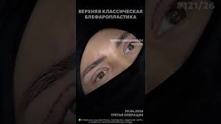 Operation 121🔥🔥 2026 #nodirbakhodirov #doctor #blefaroplasty #beauty #operatsiya #shorts #shortvideo