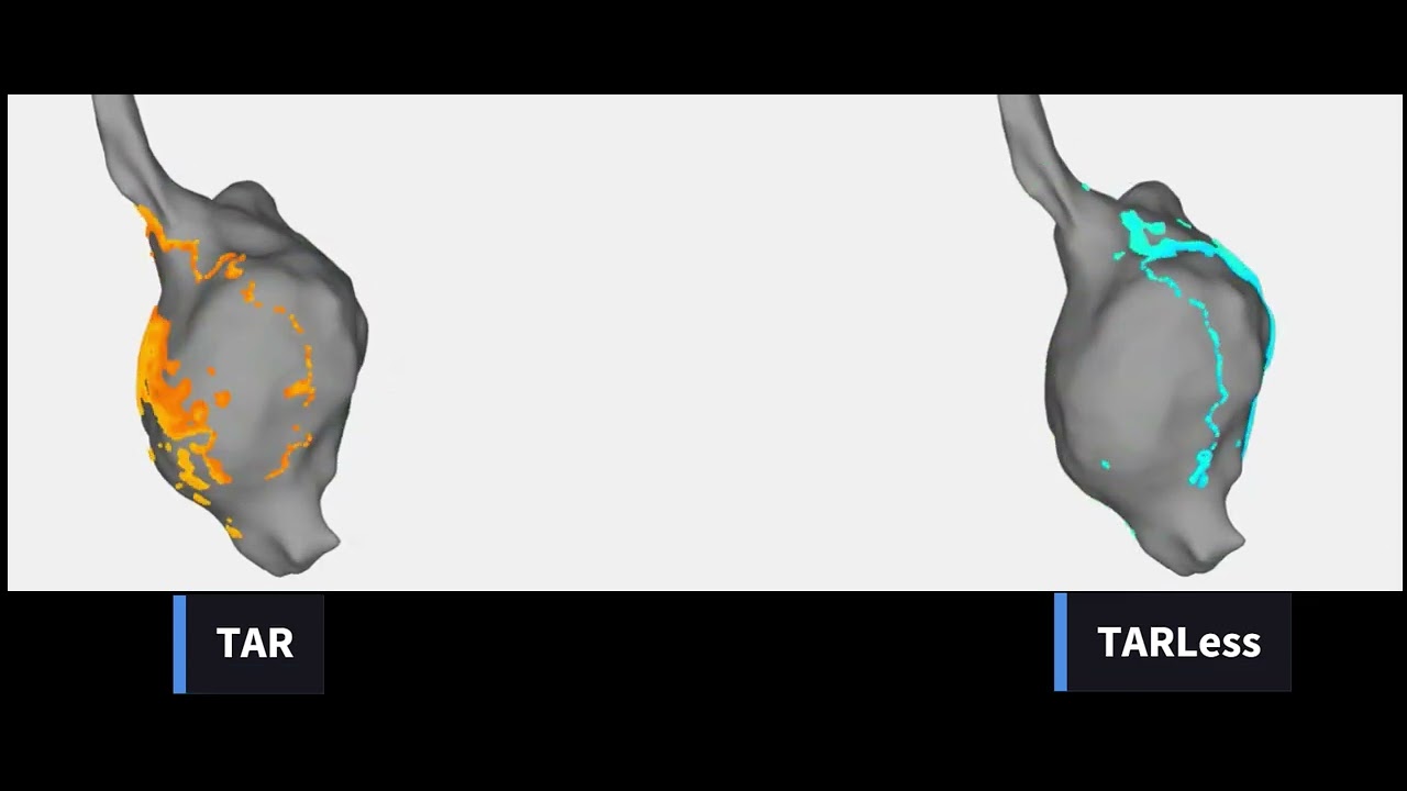 TARLess Versus TAR During an Organized Rhythm (ID 914)