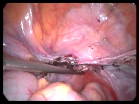 Lap. Assisted Vaginal Hysterectomy LAVH, (unedited)-Abdominal Part-2