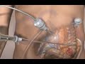 Colorectal cancer laparoscopic surgery  3d animation