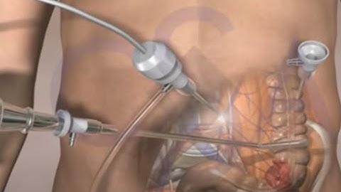 Colorectal cancer laparoscopic surgery - 3d animation