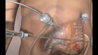 Colorectal Cancer Surgery 3D Medical Animation - Laparoscopic Procedure