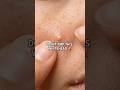 DON&rsquo;T Pop This Whitehead Until You See This 🚨 #pimple #pimplepopping #acne #acnetreatment #pimples