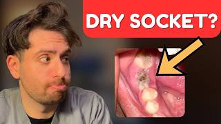 White Stuff After Tooth Extraction — Normal Healing or DRY SOCKET? Dry Socket Vs Healthy Socket