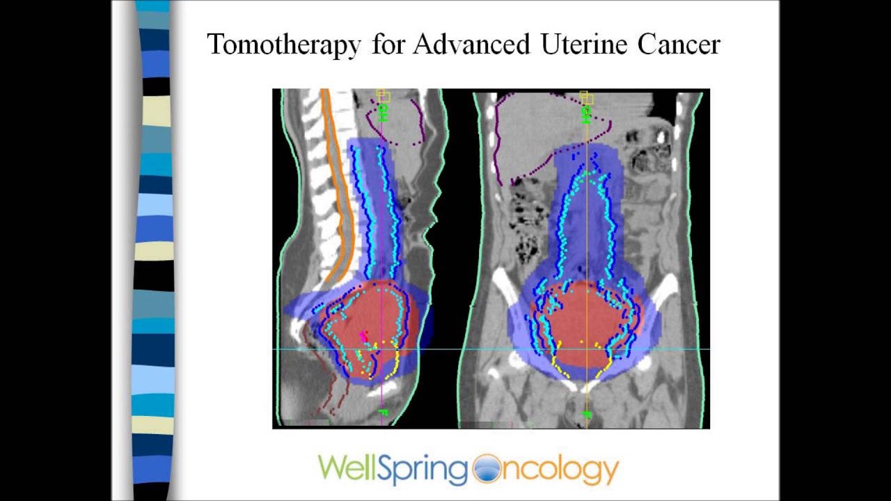 endometrial cancer radiation therapy