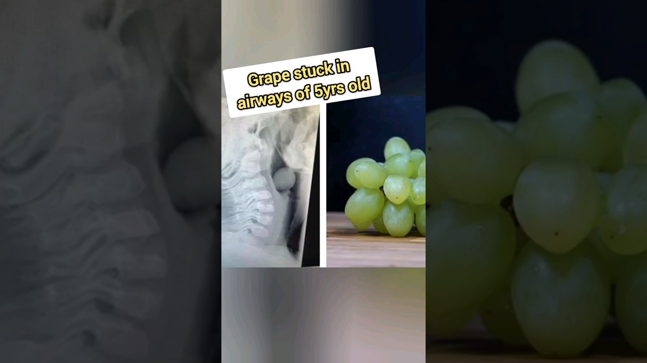 Always Cut The Grapes And Feed Your Babies under 5yrs Old 