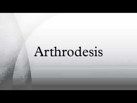 Arthrodesis