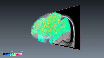 Volume Rendering and Rotation of Human Brain