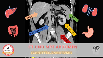 Was kann man bei einem Abdomen CT sehen?
