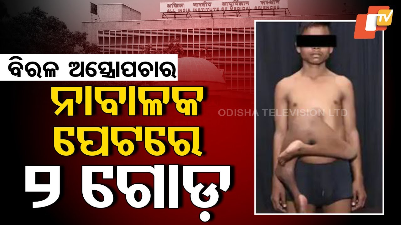 Special Story: Minor Boy Undergoes Successful Surgery to Remove 2 Extra Stomachs at Delhi AIIMS