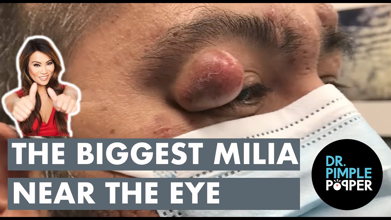 The BIGGEST Milia - YouTube