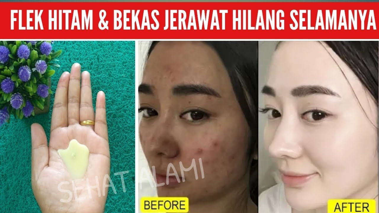 CARA MENGHILANGKAN FLEK HITAM BEKAS JERAWAT DI WAJAH DALAM