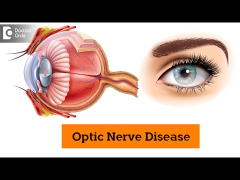 Gene therapy for optic nerve disease | Nerve Degeneration -Dr. Sunita Rana Agarwal | Doctors&rsquo; Circle