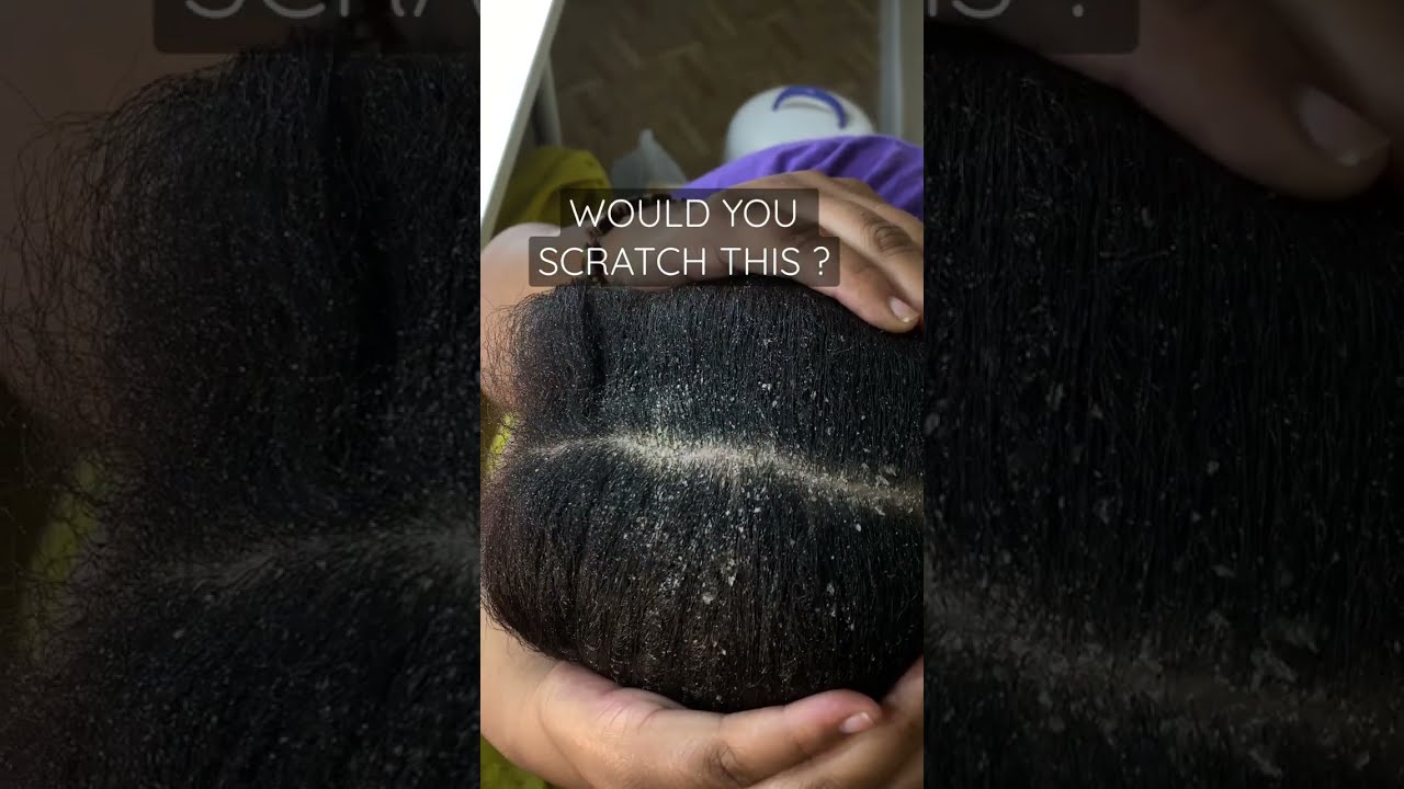 DANDRUFF FLARE UP EXTREME Shorts Viral Youtubeshorts Subscribe Comment Like Share