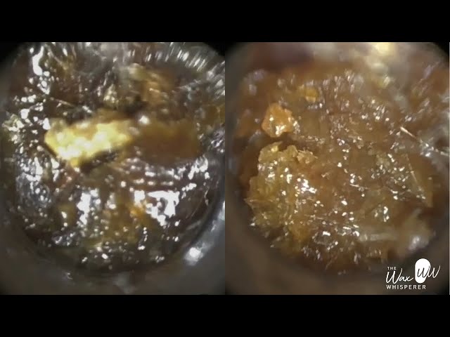 148 - Unbelievable Amount of Ear Wax Removal from Crying 7 Year Old Child using the WAXscope®️ class=