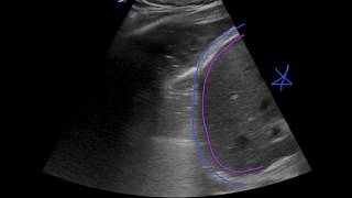 POCUS  Lung Ultrasound: Understanding B Lines and Hepatization